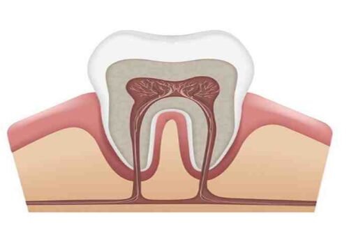 Root Canals