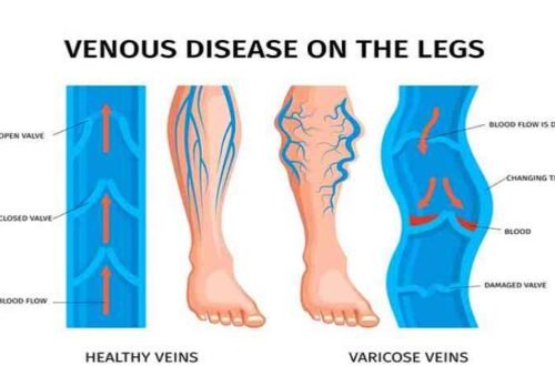 Varicose Veins