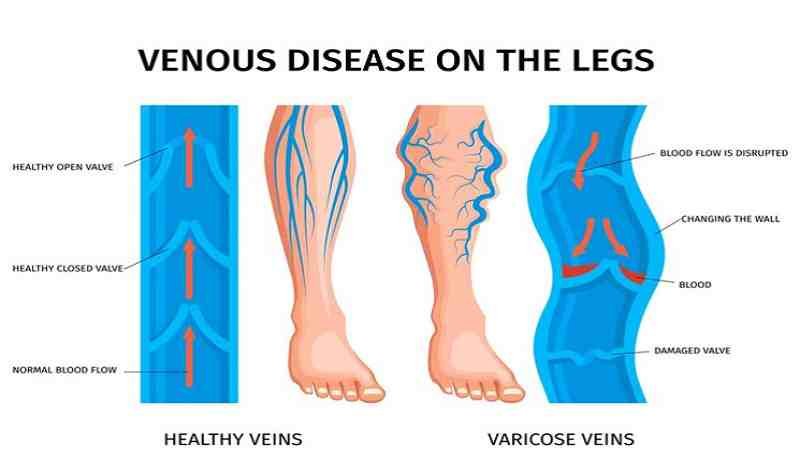 Varicose Veins